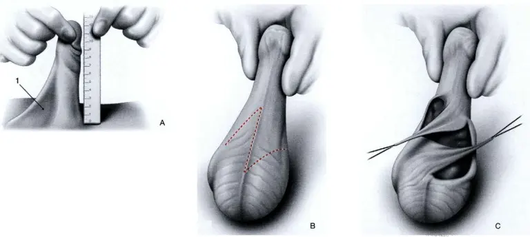 cirugia estetica escroto - Cómo reducir la piel del escroto