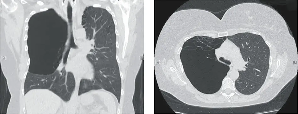 bulla en medicina - Cómo se trata una bulla pulmonar