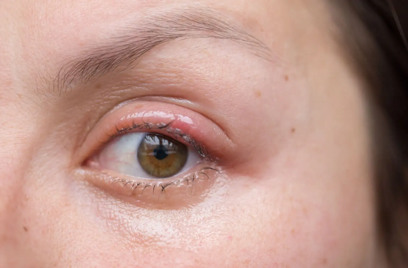 medicina para el orzuelo - Cuánto tiempo dura el orzuelo en el ojo